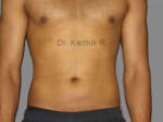 Six Packs (Abdominal etching)