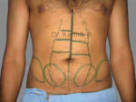 Six Packs (Abdominal etching)