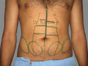 Six Packs (Abdominal etching)