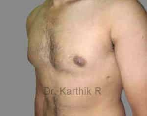 Gynecomastia (Puffy Nipples/ Male Chest Correction)