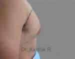 Gynecomastia (Puffy Nipples/ Male Chest Correction)