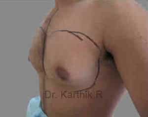 Gynecomastia (Puffy Nipples/ Male Chest Correction)