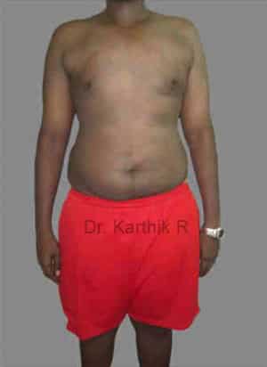 Gynecomastia (Puffy Nipples/ Male Chest Correction)