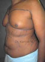 Gynecomastia (Puffy Nipples/ Male Chest Correction)