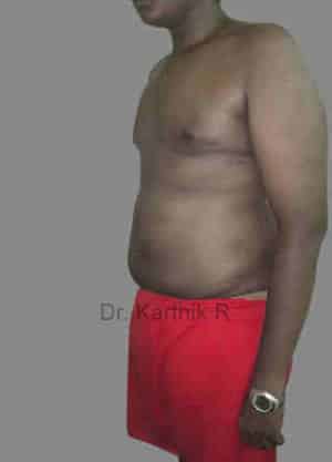 Gynecomastia (Puffy Nipples/ Male Chest Correction)