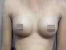 Breast Implants (Breast Augmentation)