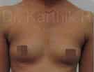 Breast Implants (Breast Augmentation)