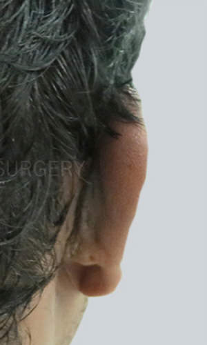 Otoplasty (Ear Correction)