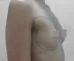 Breast Fat Fill (Breast Augmentation)