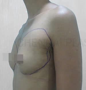 Breast Fat Fill (Breast Augmentation)