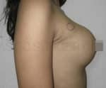 Breast Fat Fill (Breast Augmentation)