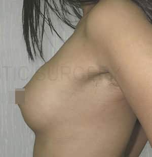 Breast Fat Fill (Breast Augmentation)