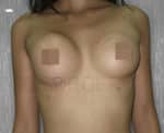 Breast Fat Fill (Breast Augmentation)