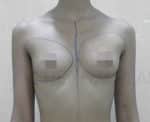 Breast Fat Fill (Breast Augmentation)