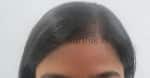 Female Hairline Advancement