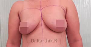 Breast Implants (Breast Augmentation)