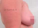 Breast Implants (Breast Augmentation)