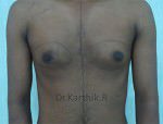 Gynecomastia (Puffy Nipples/ Male Chest Correction)