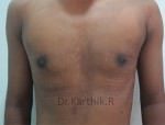 Gynecomastia (Puffy Nipples/ Male Chest Correction)