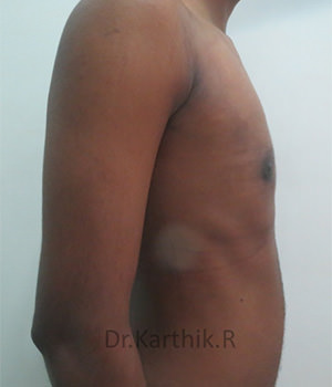 Gynecomastia (Puffy Nipples/ Male Chest Correction)