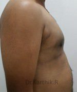 Gynecomastia (Puffy Nipples/ Male Chest Correction)