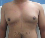 Gynecomastia (Puffy Nipples/ Male Chest Correction)