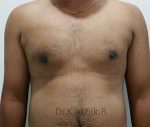 Gynecomastia (Puffy Nipples/ Male Chest Correction)