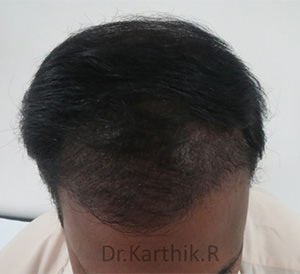 Hair Transplant