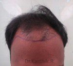 Hair Transplantation