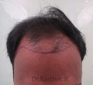 Hair Transplantation