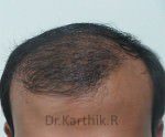 Hair Transplantation