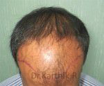 Hair Transplant