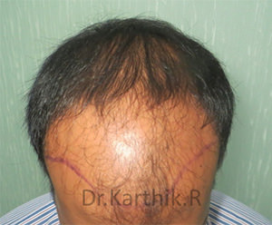 Hair Transplantation