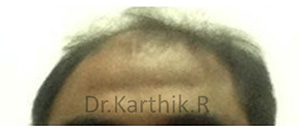 Hair Transplantation