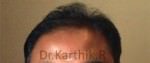 Hair Transplantation