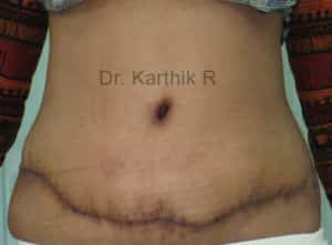 Tummy Tuck