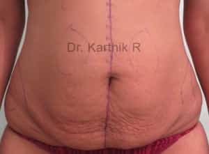 Tummy Tuck