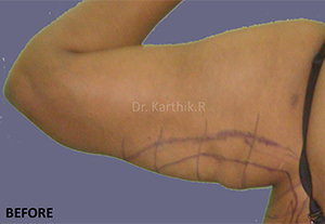 Liposuction Arms and Arm Tuck