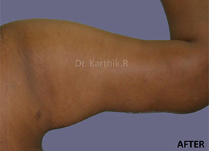 Liposuction Arms and Arm Tuck