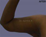 Liposuction Arms and Arm Tuck