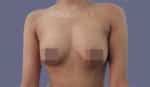 Breast Fat Fill (Breast Augmentation)