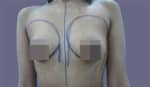 Breast Fat Fill (Breast Augmentation)