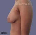 Breast Fat Fill (Breast Augmentation)