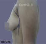 Breast Fat Fill (Breast Augmentation)