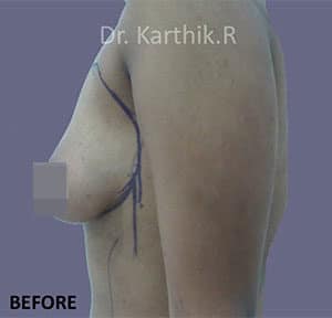 Breast Fat Fill (Breast Augmentation)