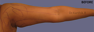 Liposuction Arms and Arm Tuck