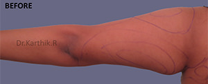 Liposuction Arms and Arm Tuck