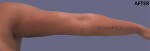 Liposuction Arms and Arm Tuck