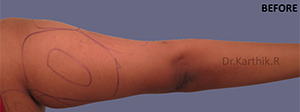 Liposuction Arms and Arm Tuck