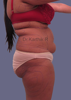 Liposuction Tummy and Back